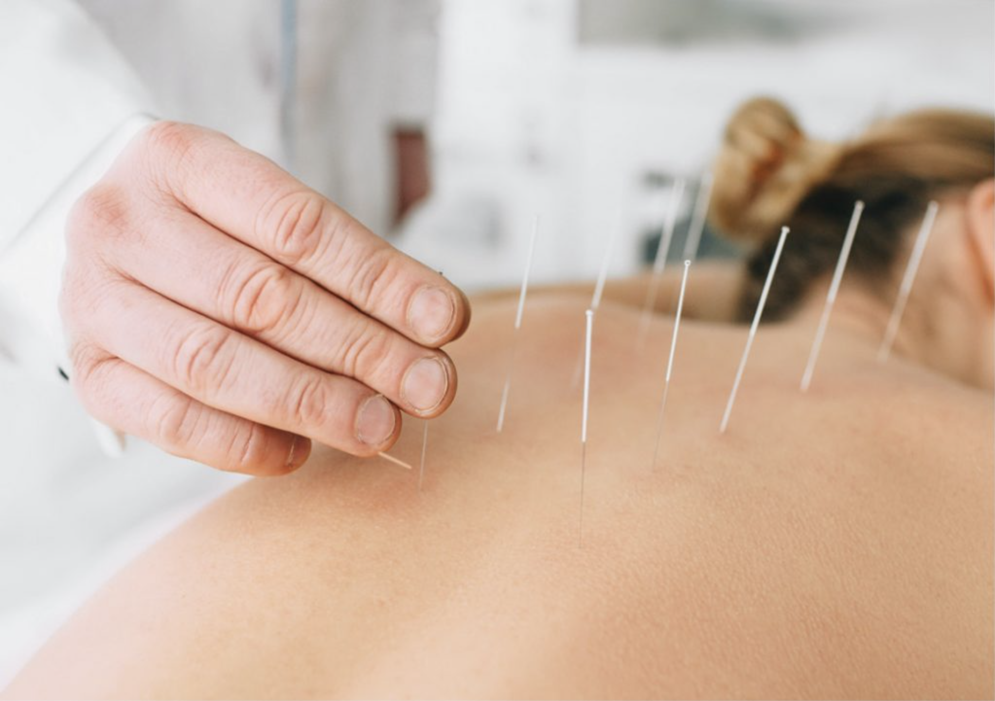 Dry Needling em Contagem — Studio Pulsa, Bairro Europa